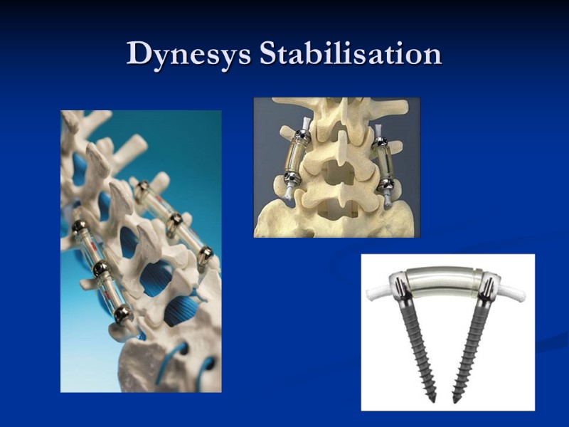 Dynesys Stabilisation